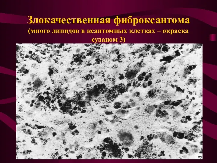 Злокачественная фиброксантома (много липидов в ксантомных клетках – окраска суданом 3)