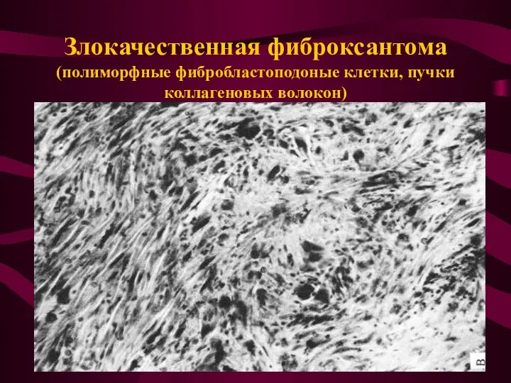 Злокачественная фиброксантома (полиморфные фибробластоподоные клетки, пучки коллагеновых волокон)
