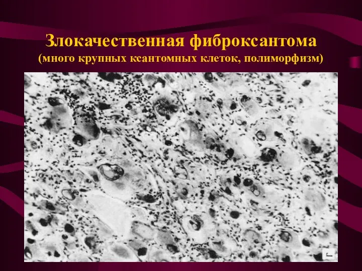 Злокачественная фиброксантома (много крупных ксантомных клеток, полиморфизм)