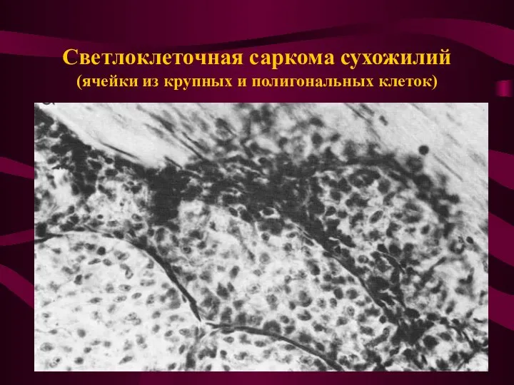 Светлоклеточная саркома сухожилий (ячейки из крупных и полигональных клеток)