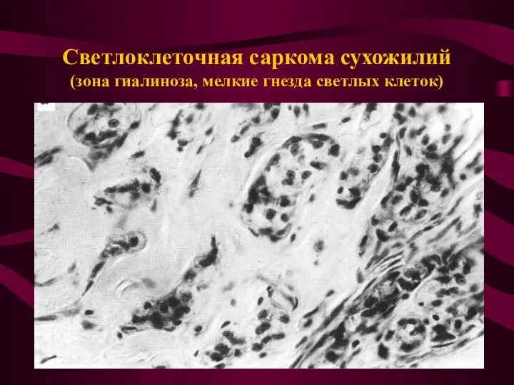 Светлоклеточная саркома сухожилий (зона гиалиноза, мелкие гнезда светлых клеток)