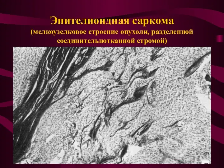 Эпителиоидная саркома (мелкоузелковое строение опухоли, разделенной соединительнотканной стромой)