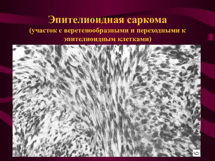 Эпителиоидная саркома (участок с веретенообразными и переходными к эпителиоидным клетками)