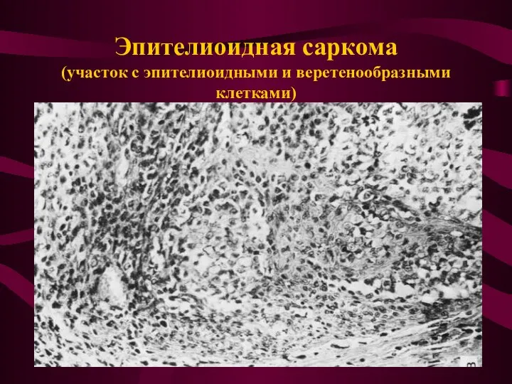 Эпителиоидная саркома (участок с эпителиоидными и веретенообразными клетками)