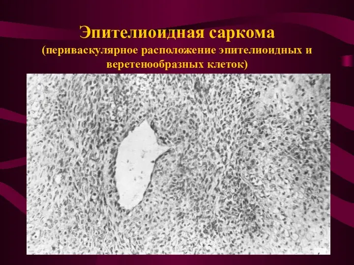 Эпителиоидная саркома (периваскулярное расположение эпителиоидных и веретенообразных клеток)