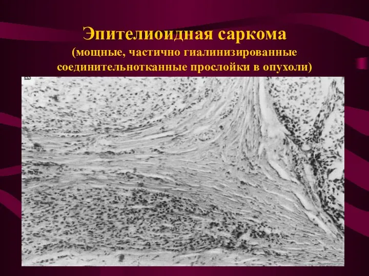 Эпителиоидная саркома (мощные, частично гиалинизированные соединительнотканные прослойки в опухоли)