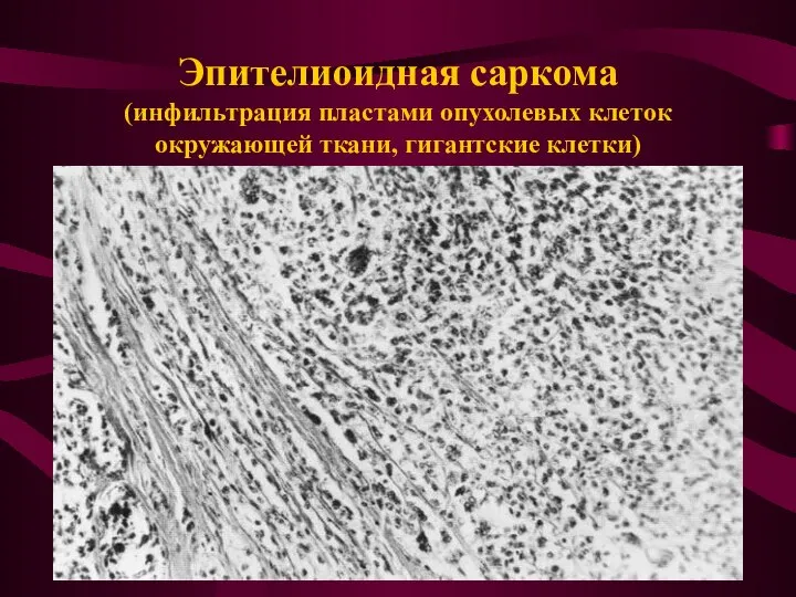 Эпителиоидная саркома (инфильтрация пластами опухолевых клеток окружающей ткани, гигантские клетки)