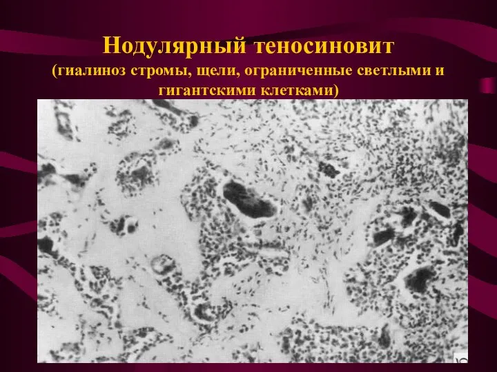 Нодулярный теносиновит (гиалиноз стромы, щели, ограниченные светлыми и гигантскими клетками)