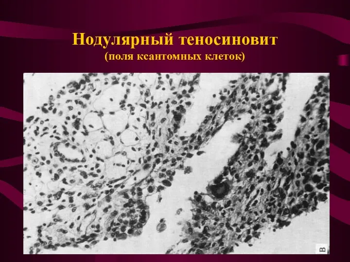 Нодулярный теносиновит (поля ксантомных клеток)