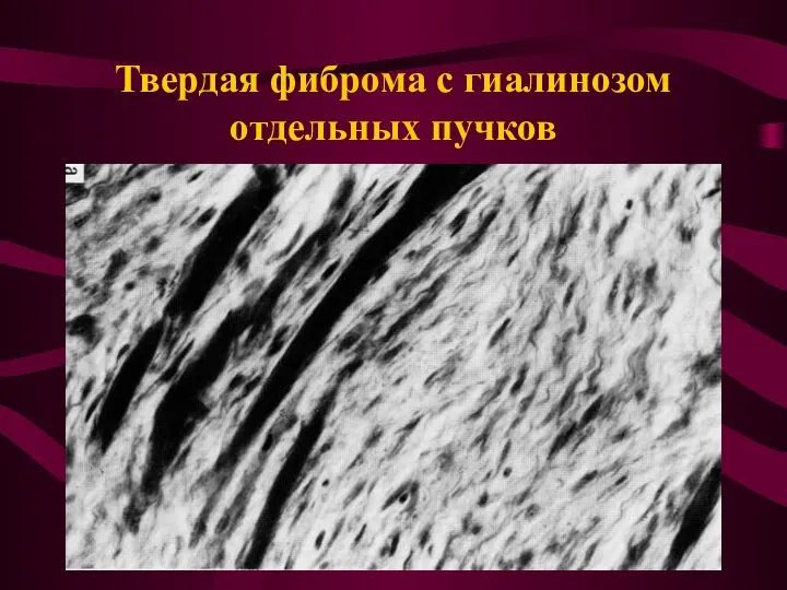 Твердая фиброма с гиалинозом отдельных пучков