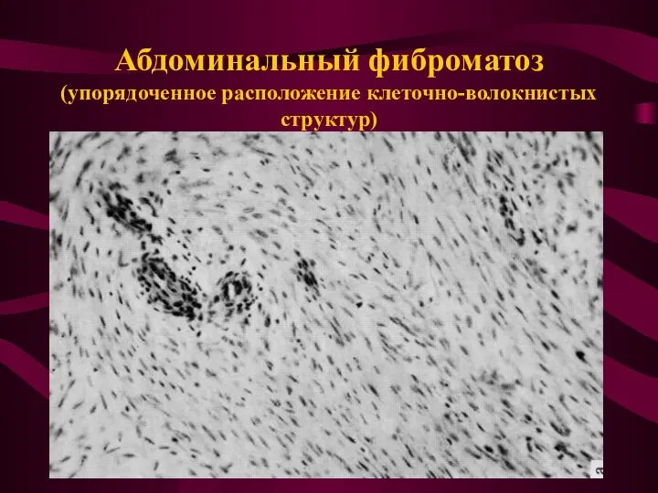 Абдоминальный фиброматоз (упорядоченное расположение клеточно-волокнистых структур)