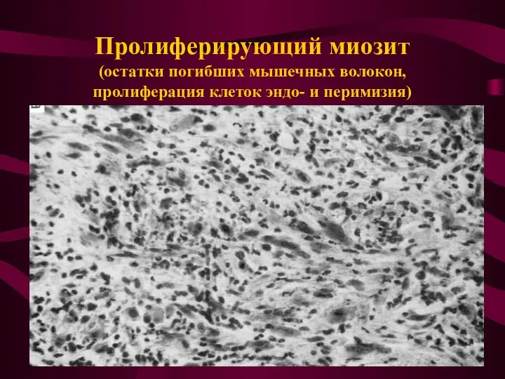 Пролиферирующий миозит (остатки погибших мышечных волокон, пролиферация клеток эндо- и перимизия)