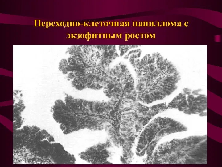 Переходно-клеточная папиллома с экзофитным ростом