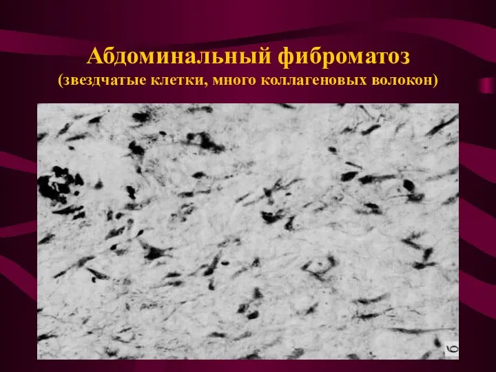 Абдоминальный фиброматоз (звездчатые клетки, много коллагеновых волокон)