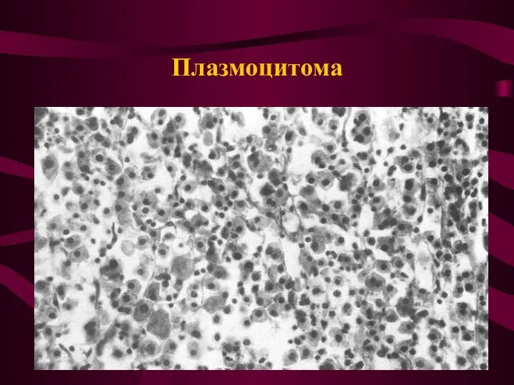 Плазмоцитома