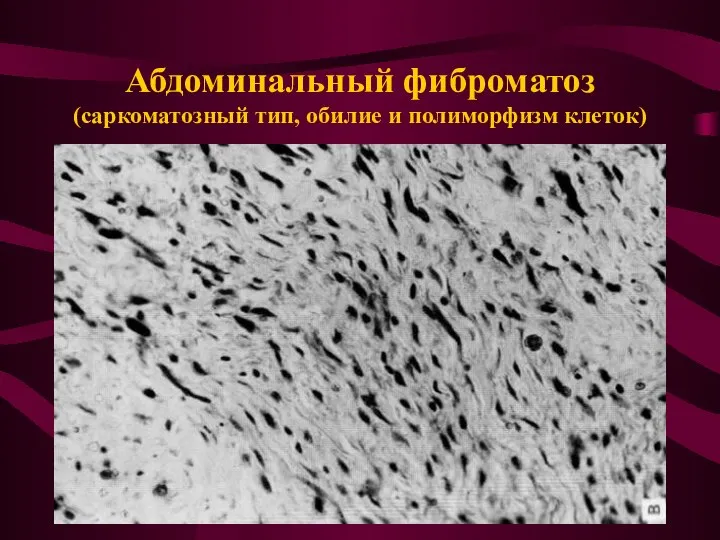 Абдоминальный фиброматоз (саркоматозный тип, обилие и полиморфизм клеток)