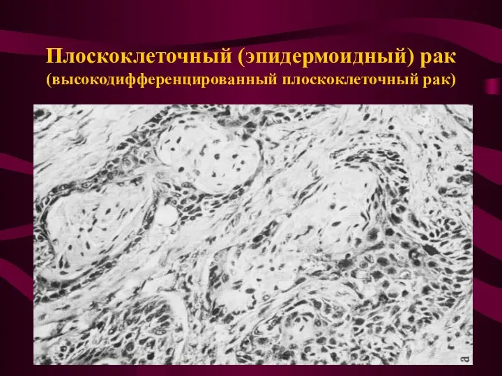 Плоскоклеточный (эпидермоидный) рак (высокодифференцированный плоскоклеточный рак)