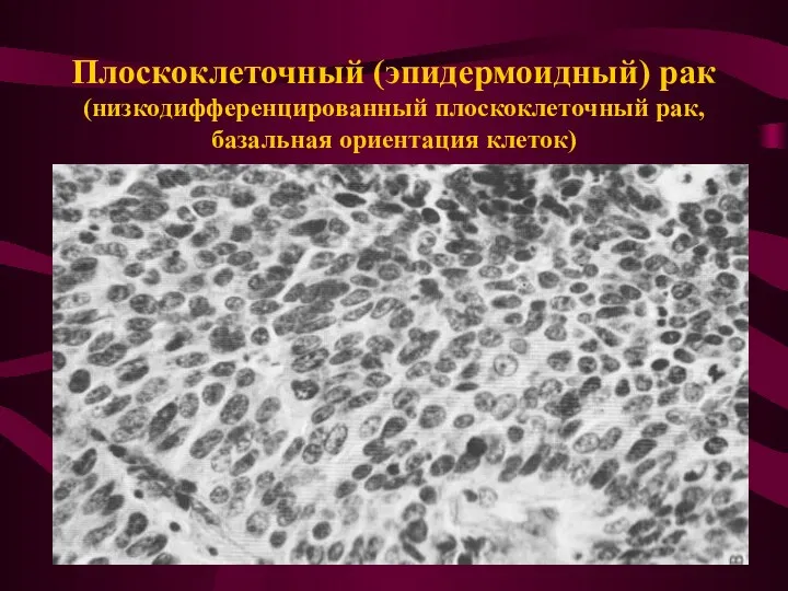 Плоскоклеточный (эпидермоидный) рак (низкодифференцированный плоскоклеточный рак, базальная ориентация клеток)