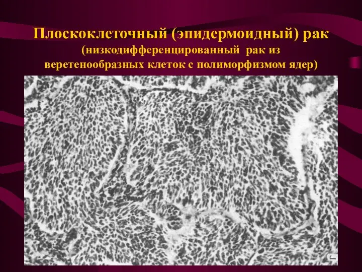 Плоскоклеточный (эпидермоидный) рак (низкодифференцированный рак из веретенообразных клеток с полиморфизмом ядер)