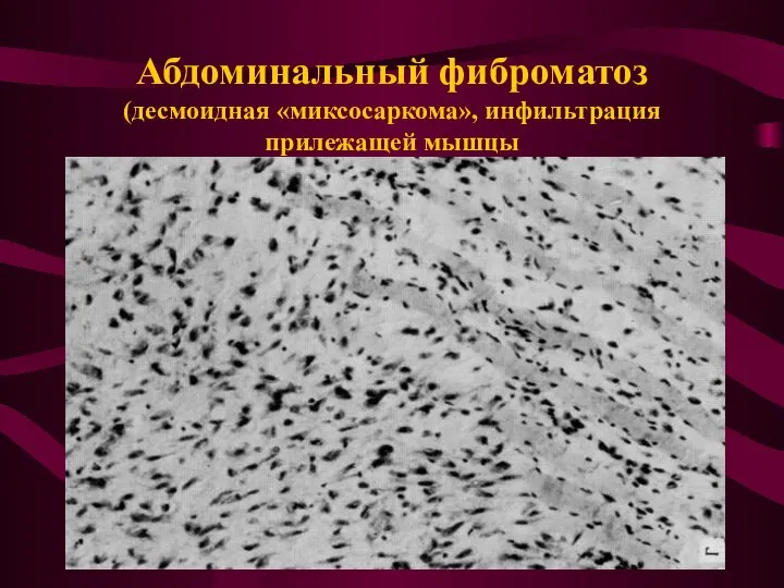 Абдоминальный фиброматоз (десмоидная «миксосаркома», инфильтрация прилежащей мышцы