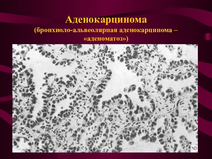 Аденокарцинома (бронхиоло-альвеолярная аденокарцинома – «аденоматоз»)