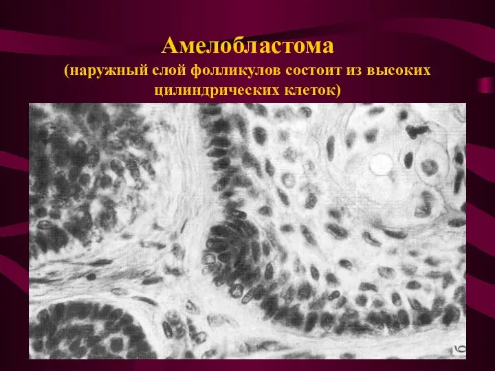 Амелобластома (наружный слой фолликулов состоит из высоких цилиндрических клеток)