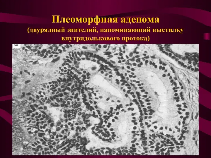 Плеоморфная аденома (двурядный эпителий, напоминающий выстилку внутридолькового протока)