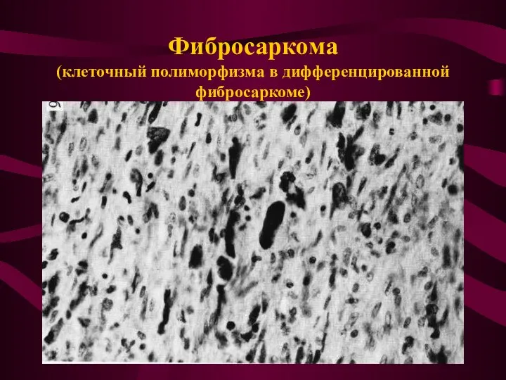 Фибросаркома (клеточный полиморфизма в дифференцированной фибросаркоме)