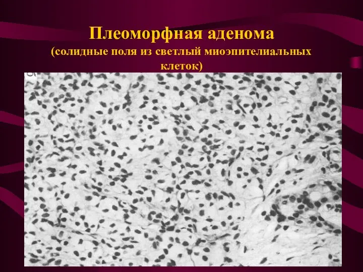 Плеоморфная аденома (солидные поля из светлый миоэпителиальных клеток)