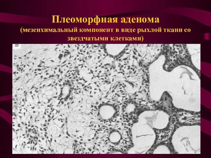 Плеоморфная аденома (мезенхимальный компонент в виде рыхлой ткани со звездчатыми клетками)