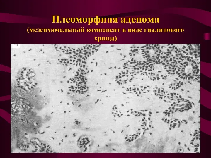 Плеоморфная аденома (мезенхимальный компонент в виде гиалинового хряща)