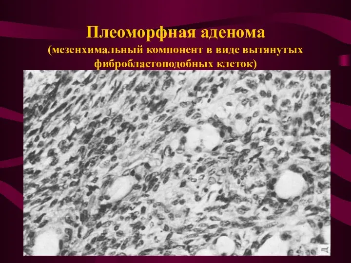 Плеоморфная аденома (мезенхимальный компонент в виде вытянутых фибробластоподобных клеток)