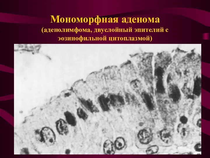 Мономорфная аденома (аденолимфома, двуслойный эпителий с эозинофильной цитоплазмой)