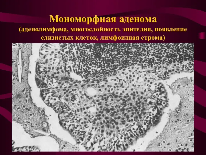 Мономорфная аденома (аденолимфома, многослойность эпителия, появление слизистых клеток, лимфоидная строма)