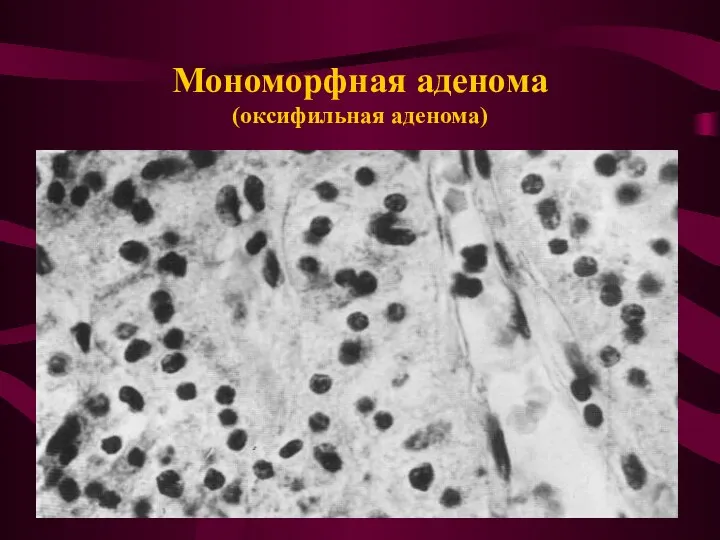 Мономорфная аденома (оксифильная аденома)