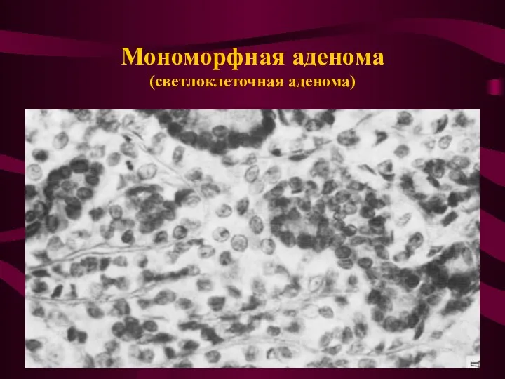 Мономорфная аденома (светлоклеточная аденома)