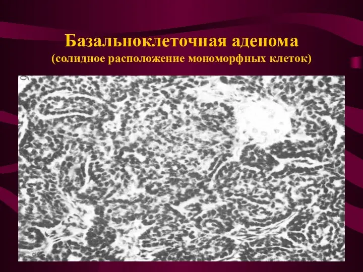 Базальноклеточная аденома (солидное расположение мономорфных клеток)