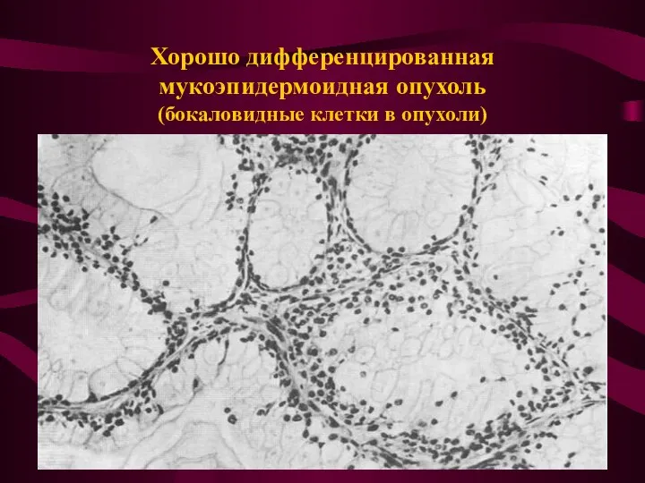 Хорошо дифференцированная мукоэпидермоидная опухоль (бокаловидные клетки в опухоли)