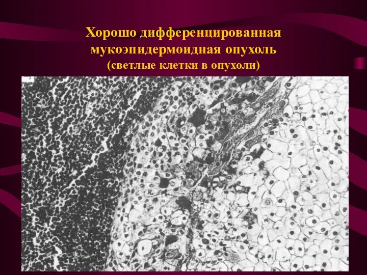 Хорошо дифференцированная мукоэпидермоидная опухоль (светлые клетки в опухоли)
