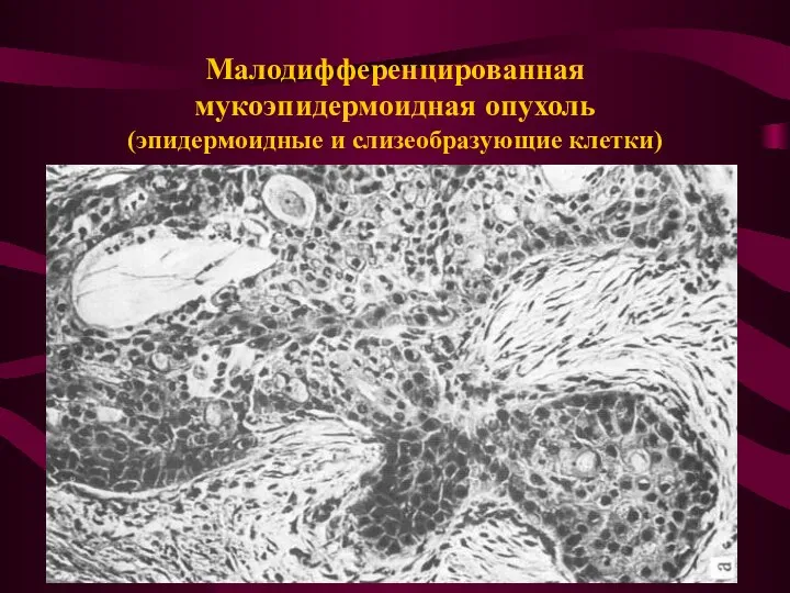 Малодифференцированная мукоэпидермоидная опухоль (эпидермоидные и слизеобразующие клетки)