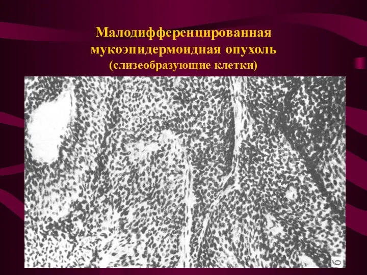 Малодифференцированная мукоэпидермоидная опухоль (слизеобразующие клетки)