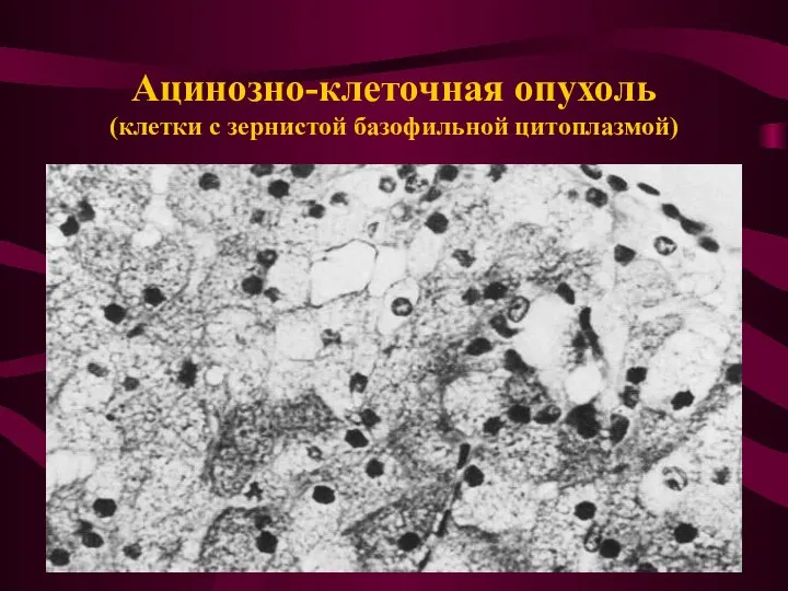 Ацинозно-клеточная опухоль (клетки с зернистой базофильной цитоплазмой)
