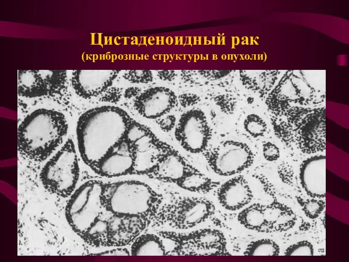 Цистаденоидный рак (криброзные структуры в опухоли)