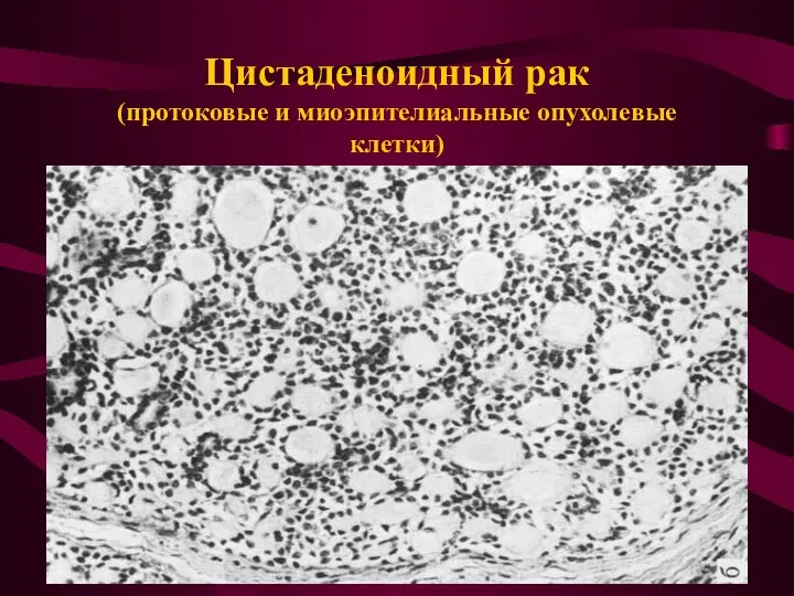 Цистаденоидный рак (протоковые и миоэпителиальные опухолевые клетки)