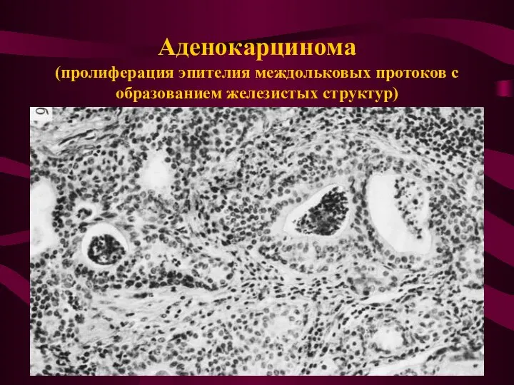 Аденокарцинома (пролиферация эпителия междольковых протоков с образованием железистых структур)