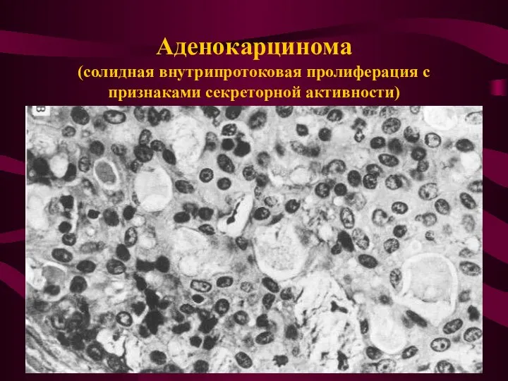 Аденокарцинома (солидная внутрипротоковая пролиферация с признаками секреторной активности)