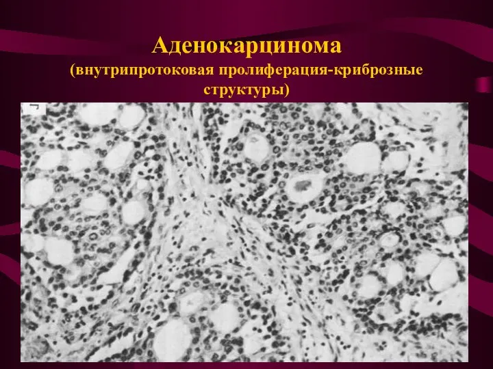 Аденокарцинома (внутрипротоковая пролиферация-криброзные структуры)