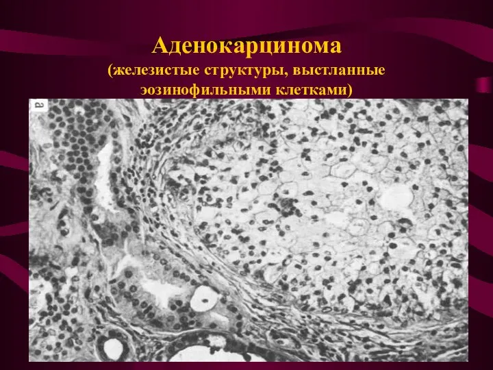 Аденокарцинома (железистые структуры, выстланные эозинофильными клетками)