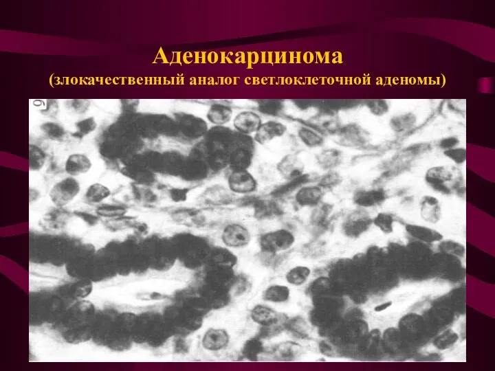 Аденокарцинома (злокачественный аналог светлоклеточной аденомы)