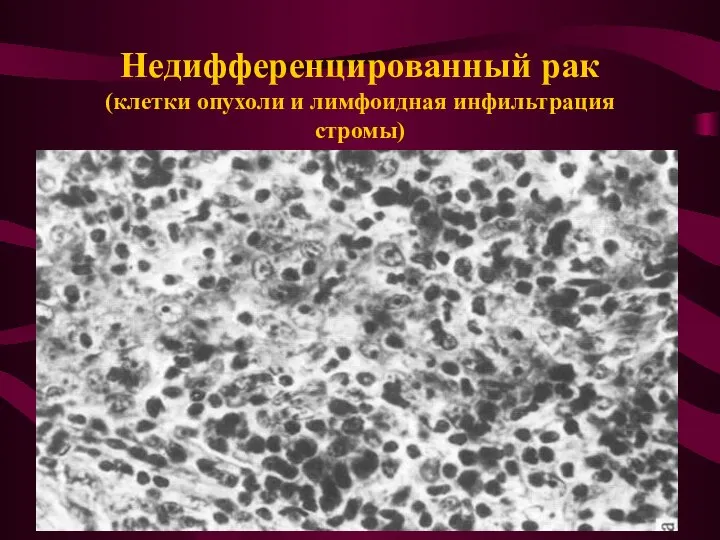 Недифференцированный рак (клетки опухоли и лимфоидная инфильтрация стромы)